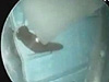 女子鼻血狂流 鼻腔揪出5公分活螞蟥